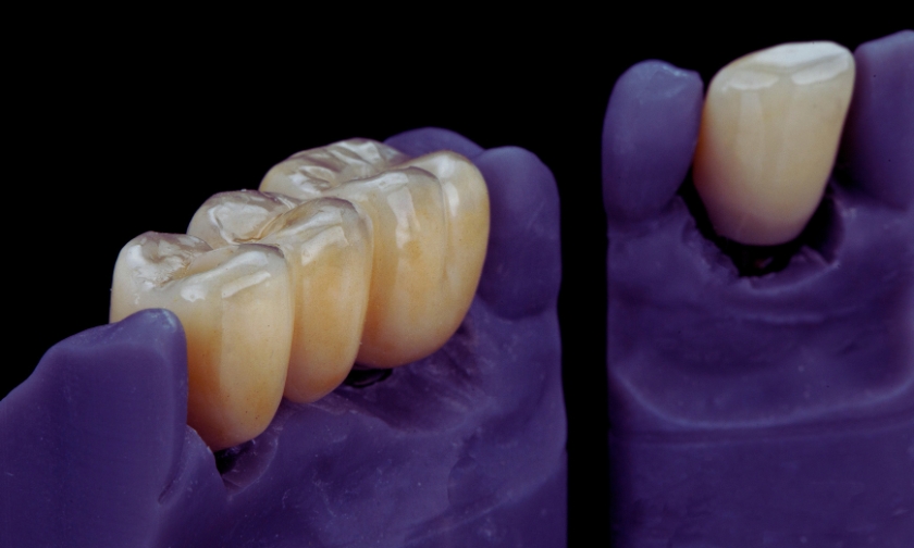 Remove Dental Cement at Home? Here’s What to Know